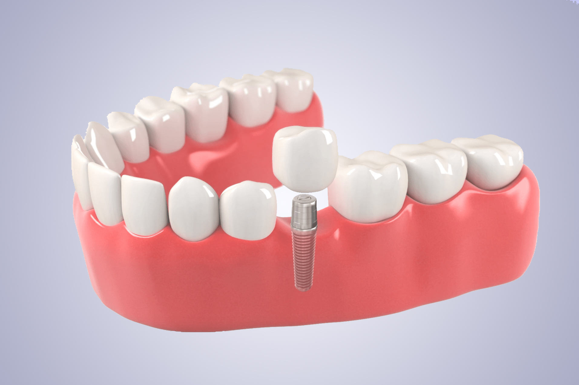 Dental Implants illustration