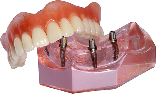 Implant Supported Dentures Model rochester ny