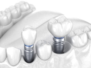 dental implant failure