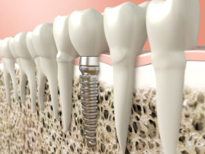 dental implant failure