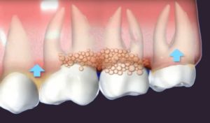 diagram depicting gum disease
