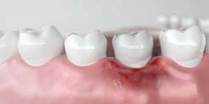 diagram depicting receding gums