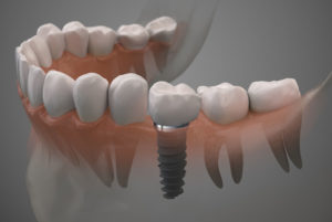 How Dental Implants Look In Your Gums