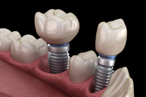 Multiple Dental Implant Model