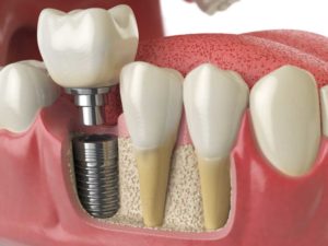 a placed dental implant