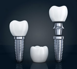 the three different parts which make up a dental implant