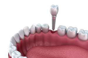 a single dental implant and post being placed into a lower jaw