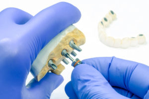 a custom dental implant model being customized by a dental professional.