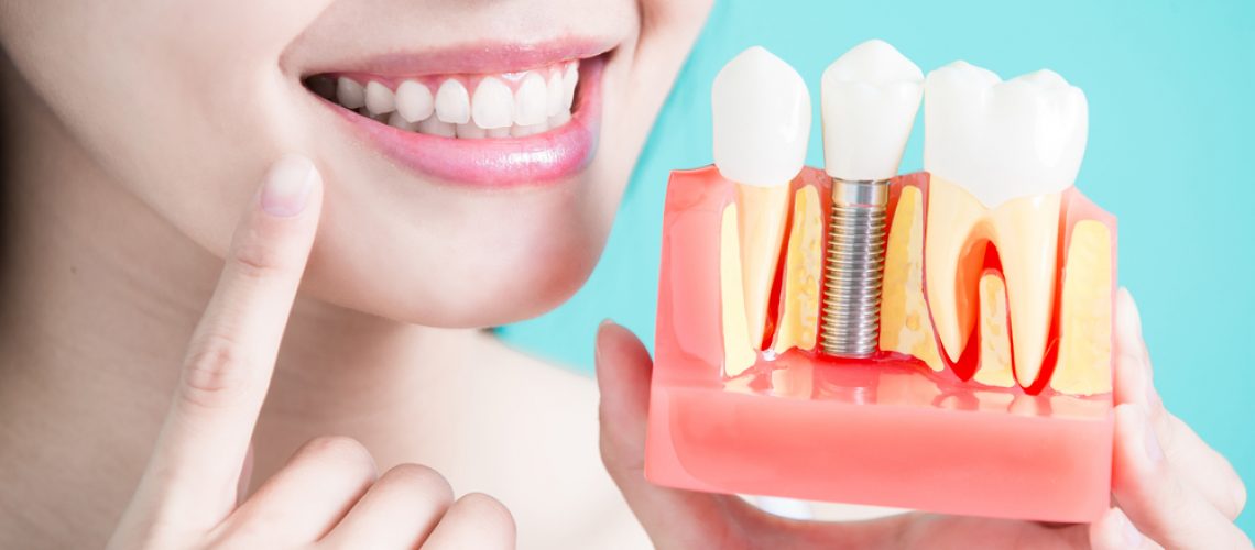 Dental Implant (2)
