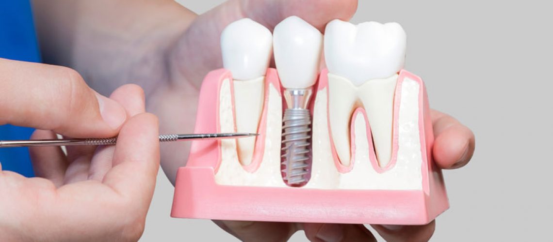 Dental Assistant Showing Off A Dental Implant In A Jawbone Cutaway Model in San Antonio, TX