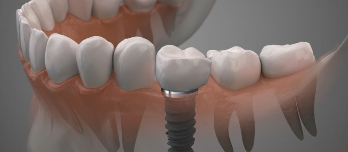 How Dental Implants Look In Your Gums