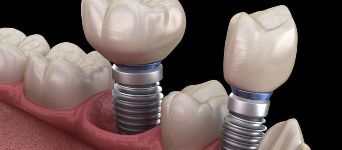 Multiple Dental Implant Model