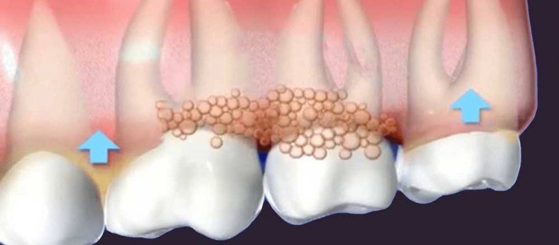 diagram depicting gums affected by gum disease