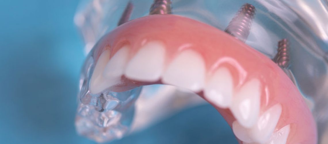 Full Arch Dental Implant Model