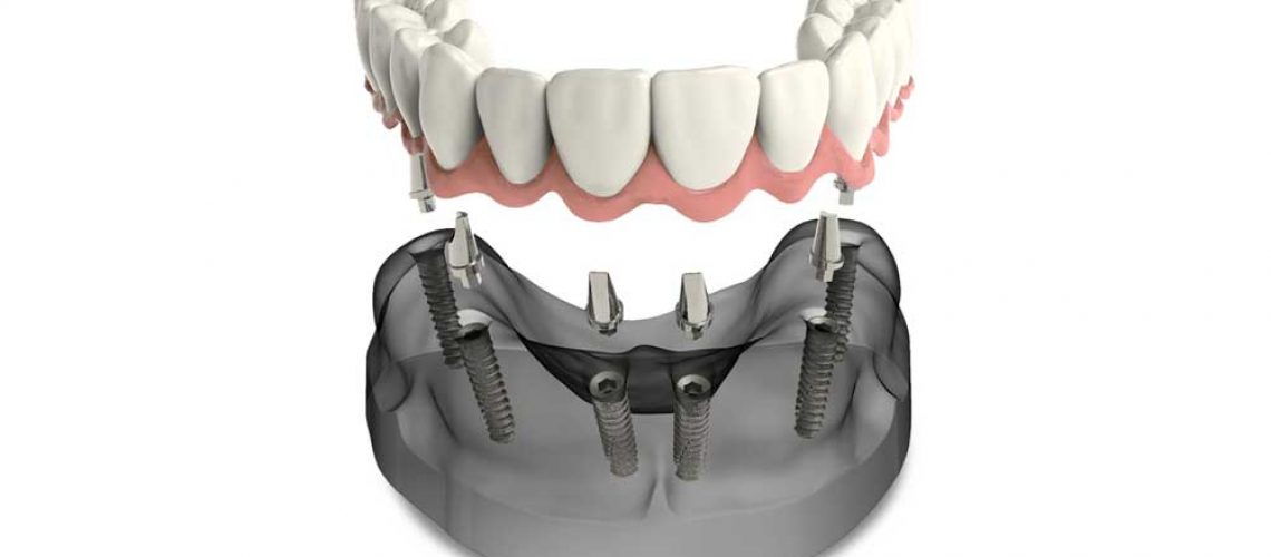 a model of full mouth dental implants
