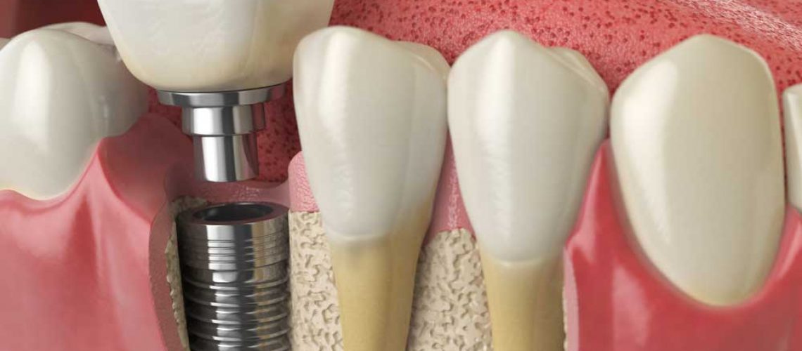 a placed dental implant
